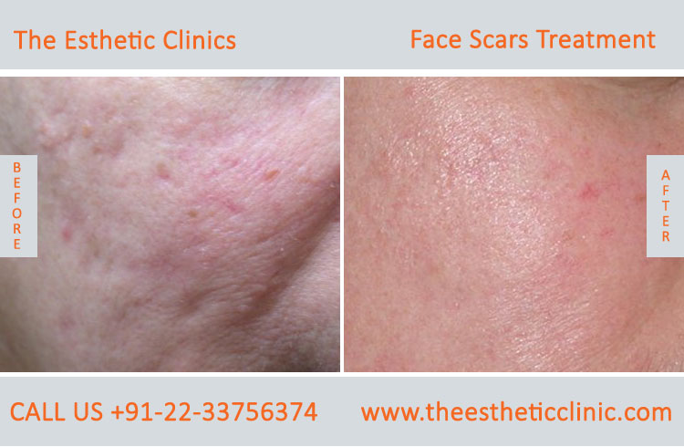 Face Scar Removal Laser Treatment before after photos in mumbai india (5)
